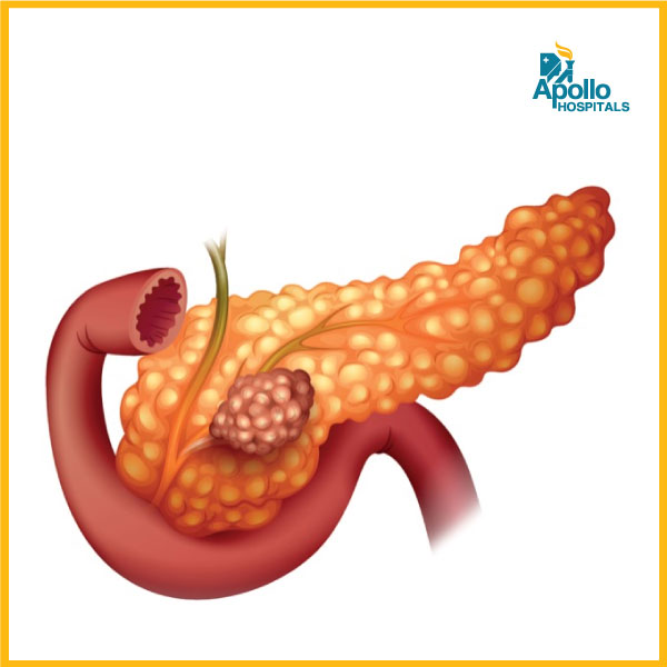 10 early warning signs of pancreatic cancer