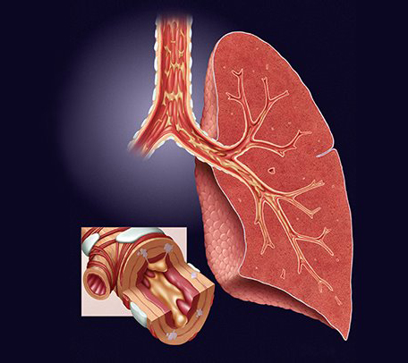 Chronic Bronchitis and COPD – Causes, Signs and Treatment