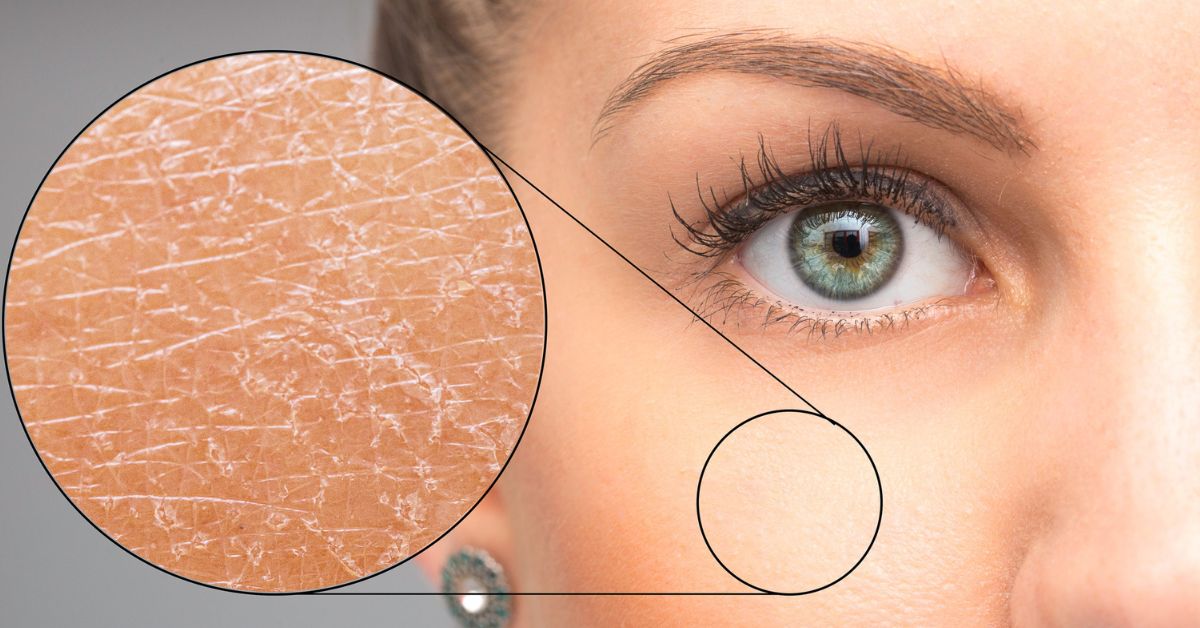 Xeroderma Pigmentosum – Symptoms, Causes, and Home Remedies