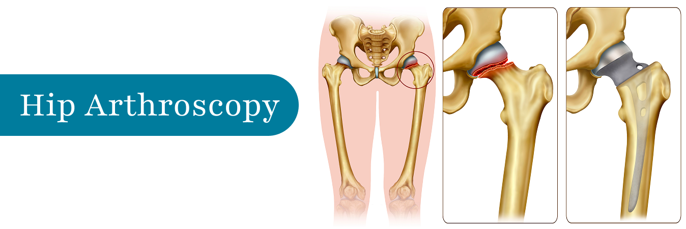 Hip Arthroscopy