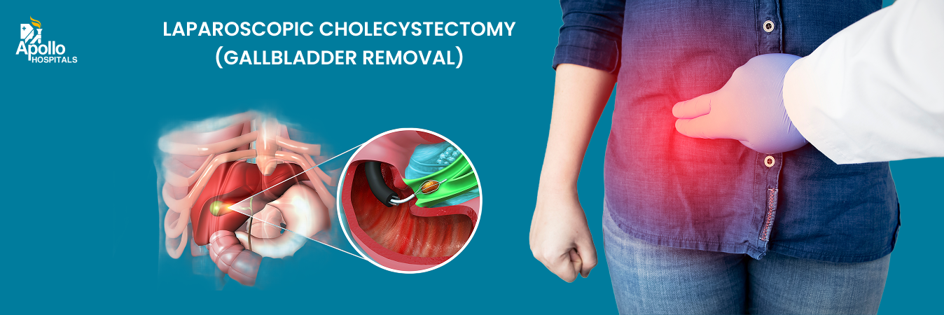 Laparoscopic Cholecystectomy